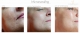 Thumbnail Microneedling